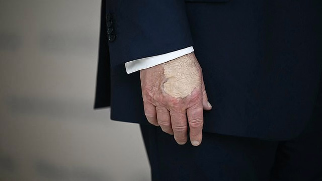 Una densa aplicación de maquillaje en la mano de Trump genera preocupación por su estado de salud.