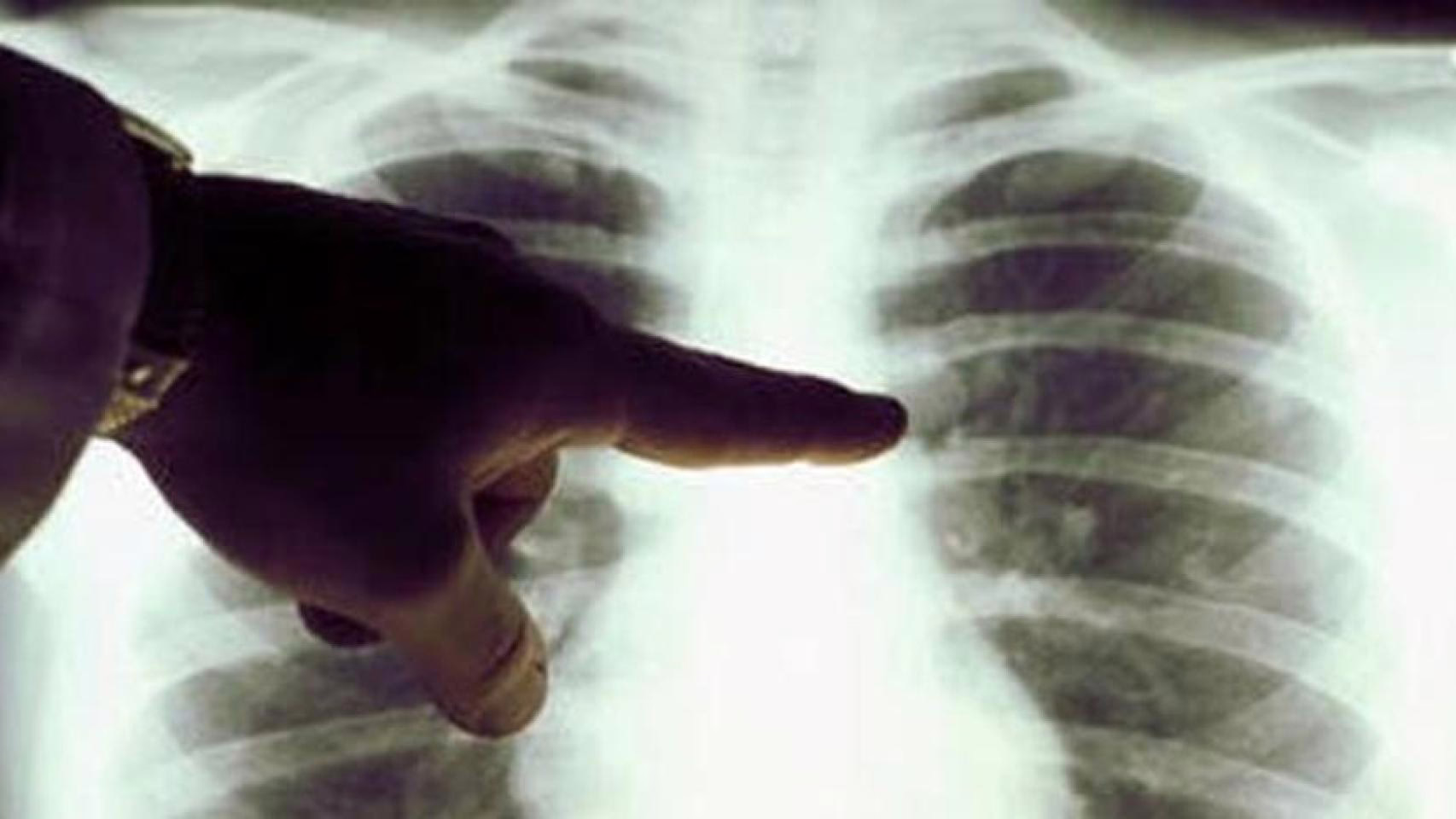 Galicia convocará a 49.000 fumadores para una prueba piloto de detección de cáncer de pulmón.