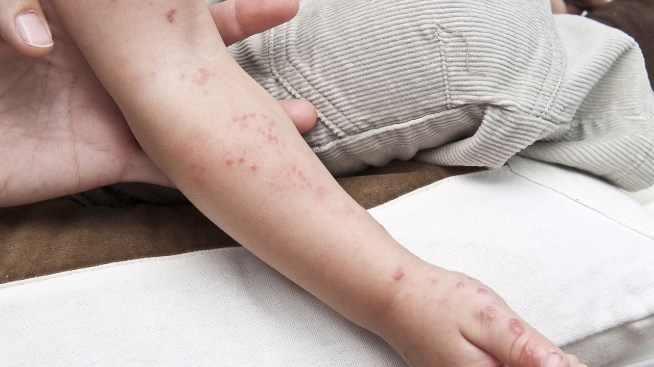 La explicación detrás de la adquisición de 640.000 dosis de vacunas contra el herpes zóster por parte de Madrid.